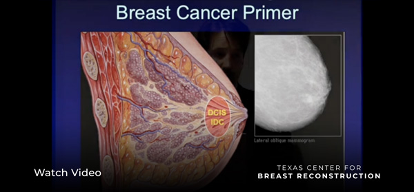 "Living Beyond Breast Cancer" - Breast Reconstruction Part 2