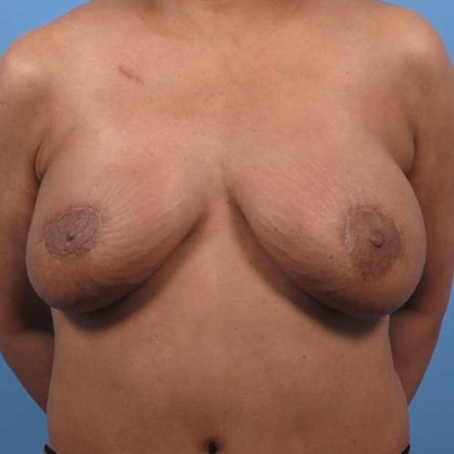 Case--199 | After DIEP FLAP