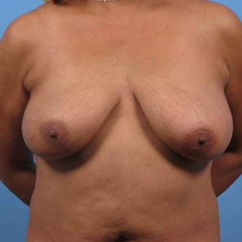 Case--199 | Before DIEP FLAP