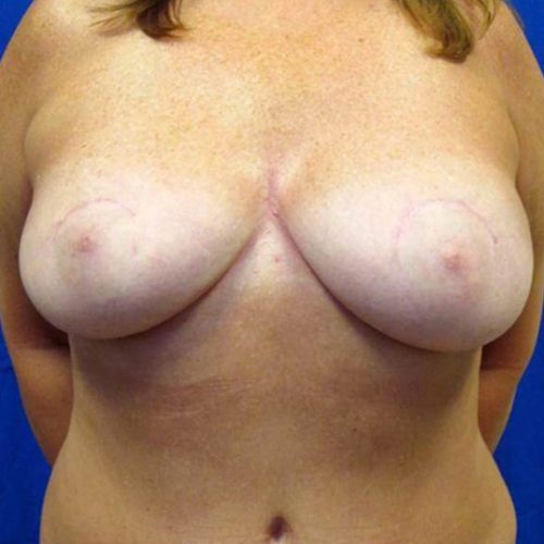 Case--1868 | After DIEP FLAP