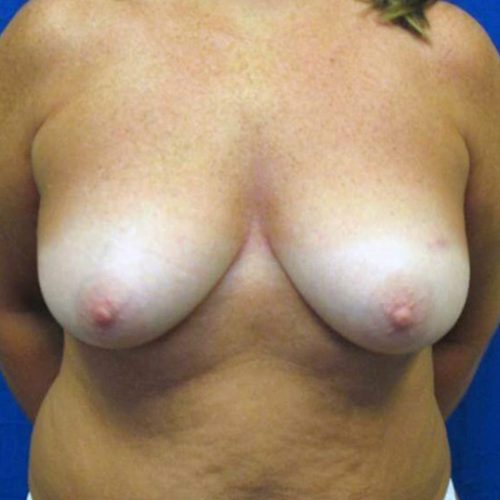 Case--1868 | Before DIEP FLAP