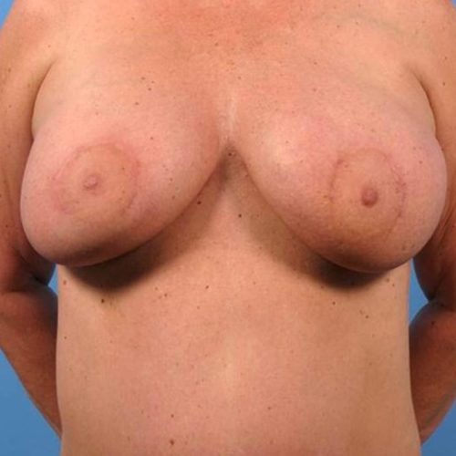 Case--2813 | After DIEP FLAP