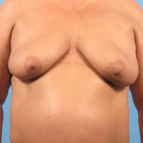 Case--2813 | Before DIEP FLAP