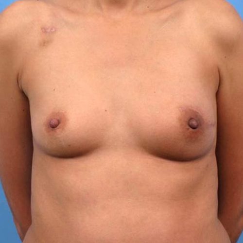 Case--3717 | After DIEP FLAP