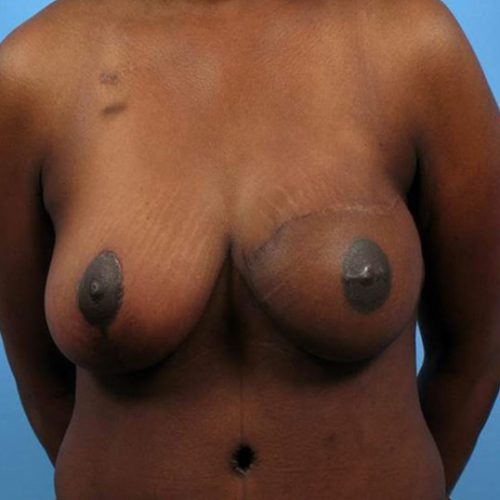 Case--338 | After DIEP FLAP