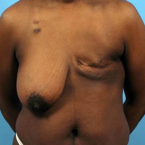 Case--338 | Before DIEP FLAP