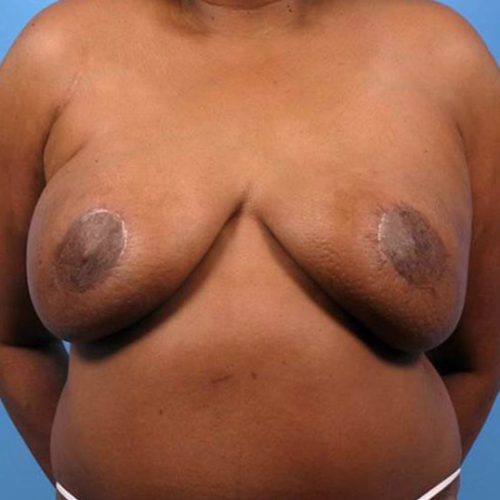 Case--2204 | After DIEP FLAP