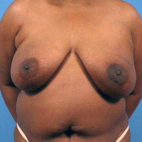 Case--2204 | Before DIEP FLAP