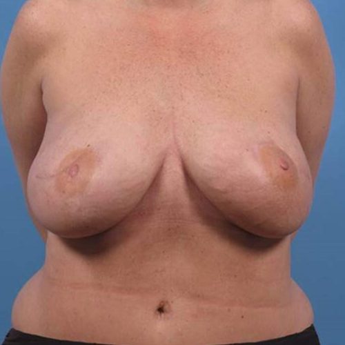 Case--2756 | After DIEP FLAP