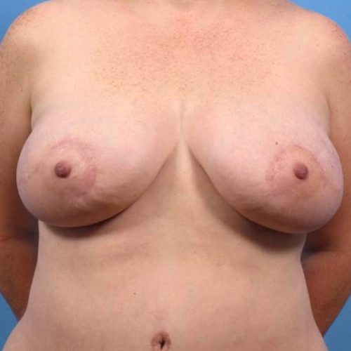 Case--9342 | After DIEP FLAP