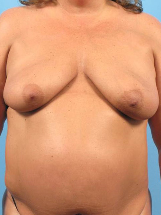 Case--4434 | Before Breast
